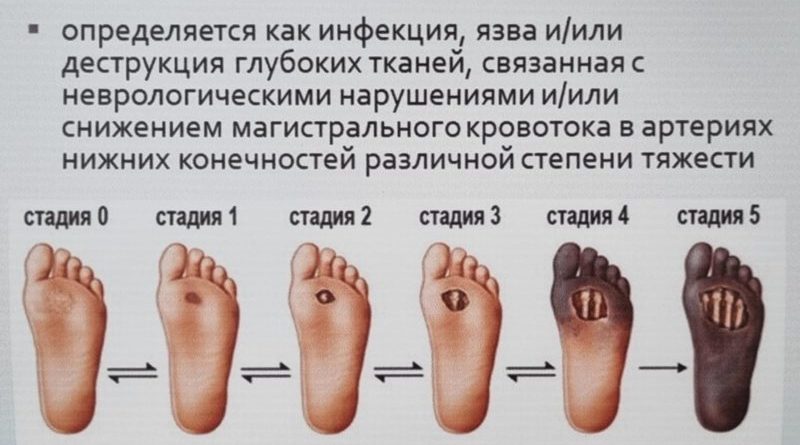 Что такое синдром диабетической стопы?