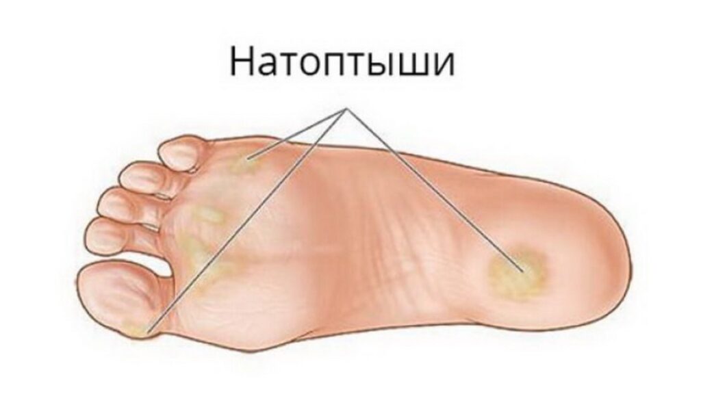 В чем разница между мозолью и натоптышем?