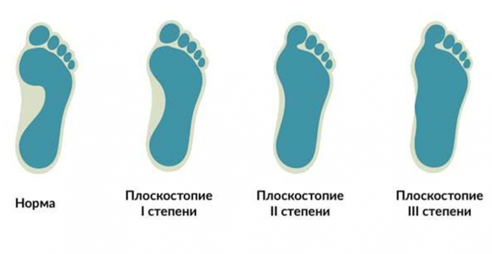 Что такое плоскостопие?
