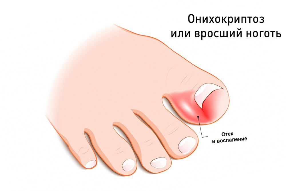 Почему врастают ногти?