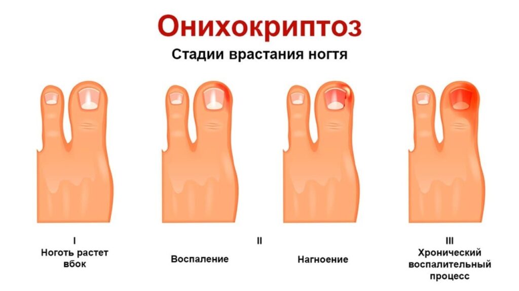 Какие первые признаки вросшего ногтя?