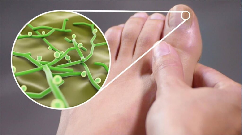 Невидимая связь: как стресс провоцирует грибок на ногах и мешает его лечению