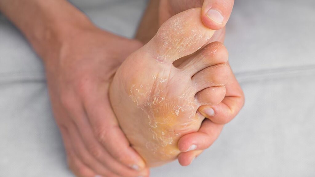 Невидимая связь: как стресс провоцирует грибок на ногах и мешает его лечению